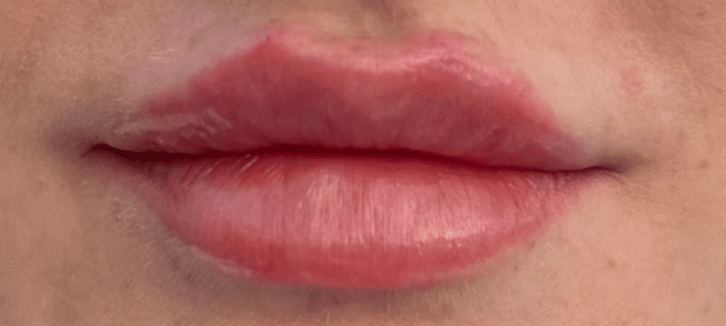 Lipfiller after
