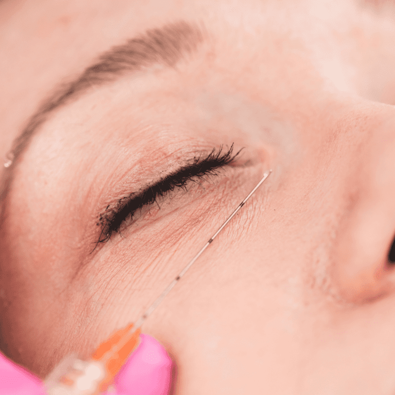 Ergebnis einer Tränenrinnen-Behandlung – frisches und jugendliches Aussehen durch Filler.