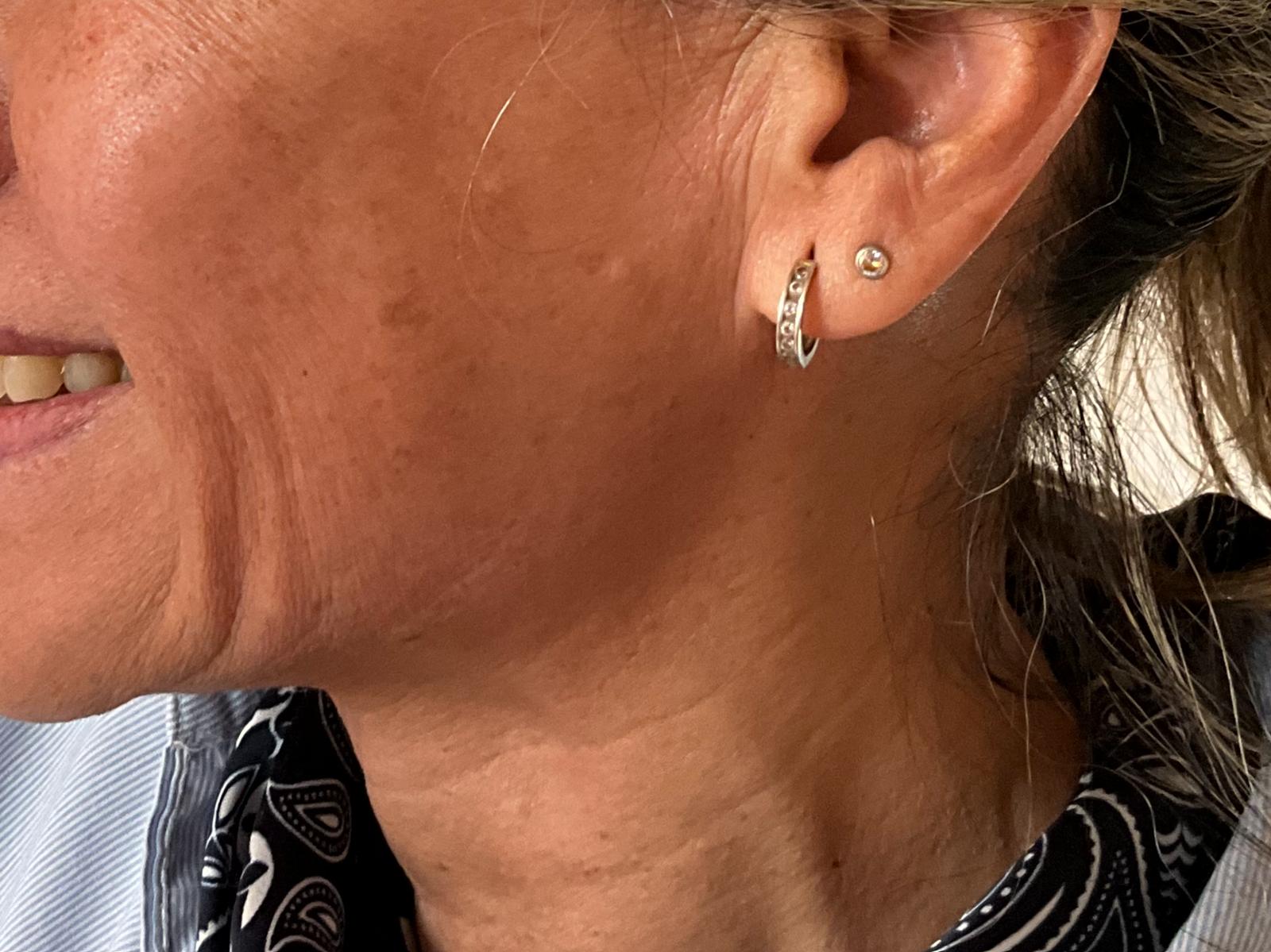 Jawline Behandlung mit Radiesse Vorher